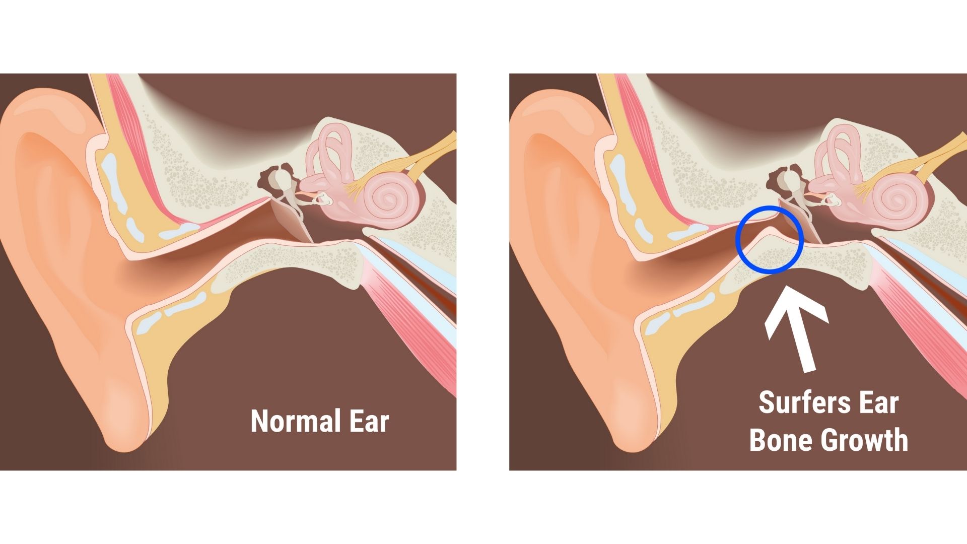 surfers-ear-diagram